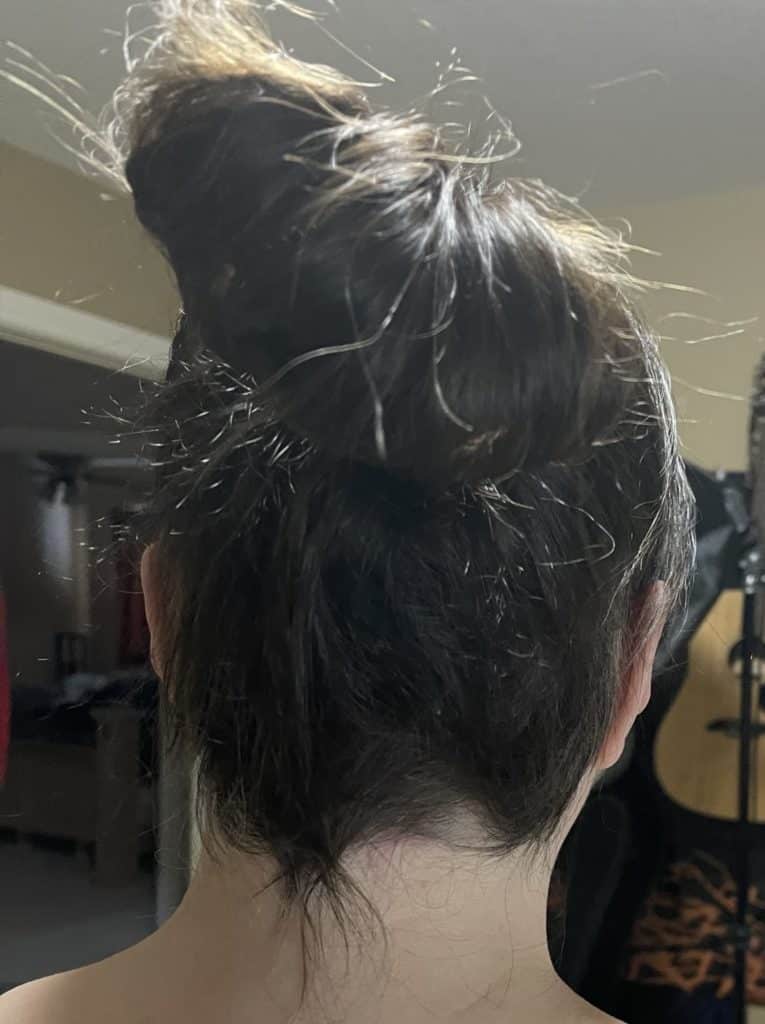 Ophiasis Alopecia Replace: Finish Of August To Center Of December